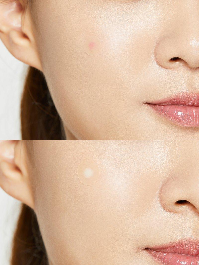 Acne Pimple Master Patch (1pack x 24patches)