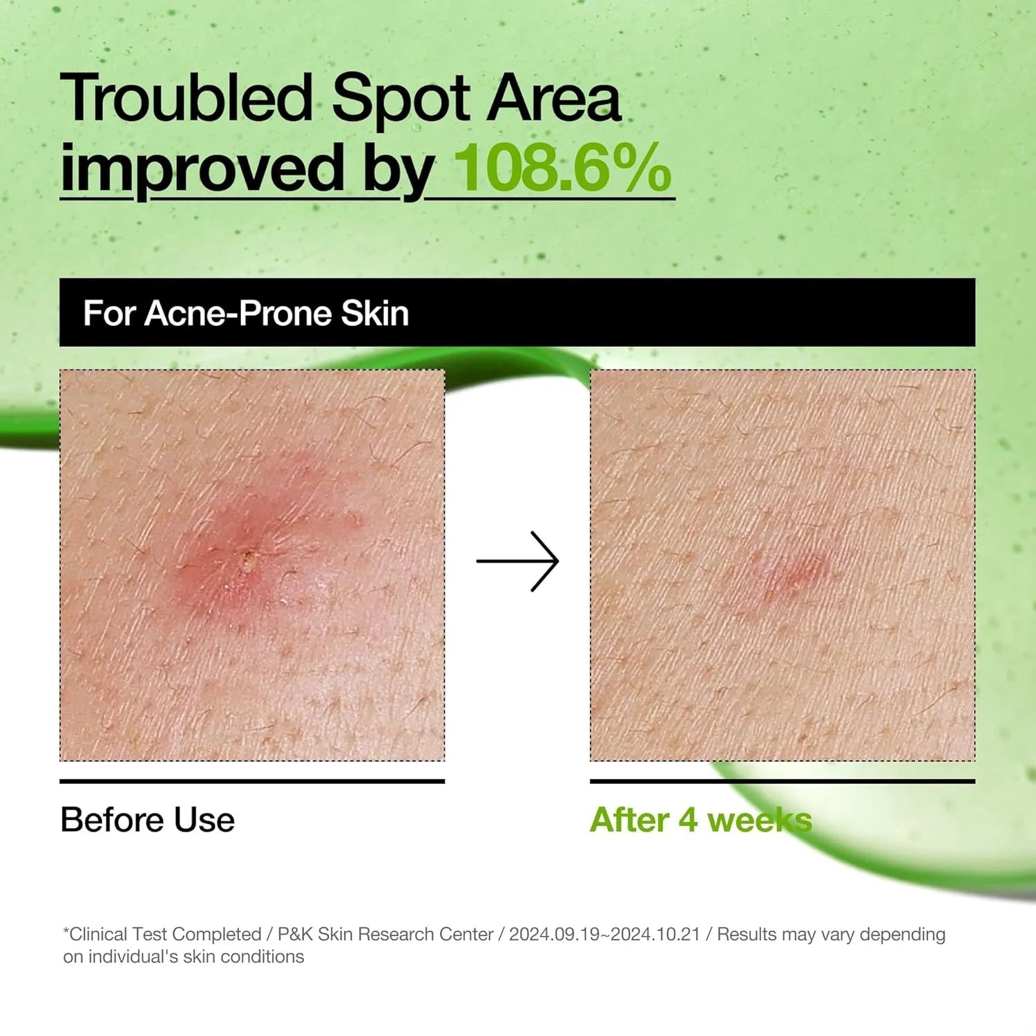 Anua Azelaic Acid 10 Hyaluron Redness Soothing Serum - 30ML